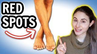 Why you get RED SPOTS ON THE LEGS amp HOW TO GET RID OF THEM  Dermatologist DrDrayzday [upl. by Booma]