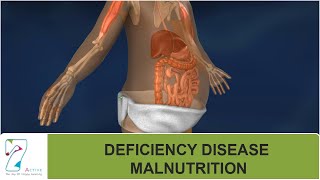 DEFICIENCY DISEASE  MALNUTRITION [upl. by Guimar]