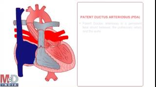 Patent Ductus Arteriosus [upl. by Hujsak]