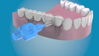 Limpie los laterales de sus implantes con un cepillo interdental TePe [upl. by Rafe48]