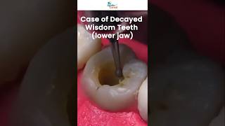 Decayed Wisdom Tooth Removal  Advanced Treatment Procedure at Apollo Dental dentalcare [upl. by Alletse]