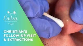 Christian Comes Back for More Blackhead Extractions [upl. by Damicke369]