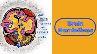 Brain Herniations and Raised ICP [upl. by Llewsor]