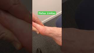 Stiff big toe Is it Hallux Limitus [upl. by Felic481]