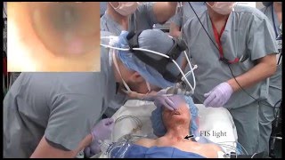 Inhalation Induction Apneic Intubation in a distorted airway from AOD [upl. by Notreve501]