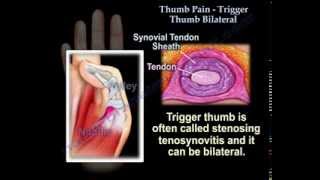 Thumb Pain  Trigger Thumb  Bilateral  Everything You Need To Know  Dr Nabil Ebraheim [upl. by Annoeik]