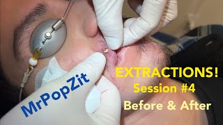 Severe Acne extractions Session 4 amazing before and after So many pops [upl. by Tristas836]