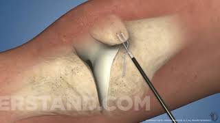 Cirurgia do Ligamento Patelofemoral medial [upl. by Esalb410]