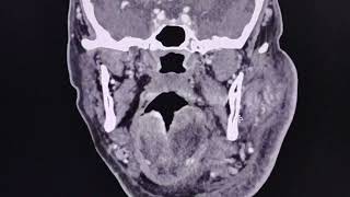 Acute sialadenitis of the parotid gland  CT findings [upl. by Tamqrah]