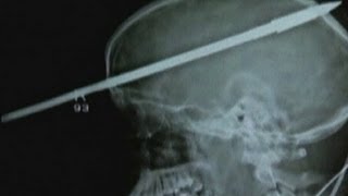 Teenager in Florida survives harpoon through his head [upl. by Marmaduke978]