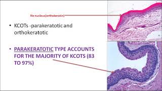 ORALPATH CHAP 3 PART 1  ODONTOGENIC CYSTS  ENGLISH [upl. by Belle]