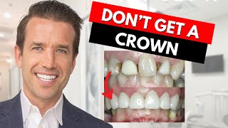 Watch this before getting a Dental Crown [upl. by Tita]