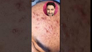 Acne EXTRACTIONS on forehead [upl. by Ayanej]