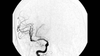 MCA stenosis angio [upl. by Allie]