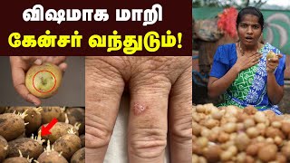 Health benefits உருளைக்கிழங்கு இப்படி வாங்குனா ஆப்பு தான் Potato chips  Potato Fry Recipe [upl. by Gnouv]