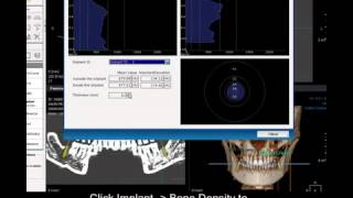 DVR Module Implant planning [upl. by Ayote]