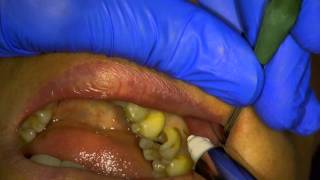 ANESTHESIE DENTAIRE DIPLOIQUE PAR VOIE OSTEOCENTRALE INTER RADICULAIRE 36 [upl. by Kenon208]