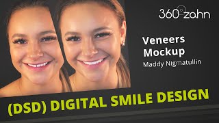 Digital Smile Design DSD  Veneers  Maddy Nigmatullin  Mockup  360°zahn [upl. by Htessil]