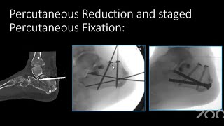 From MIS to mis Evolution of Calcaneal Fracture Management [upl. by Enylodnewg]