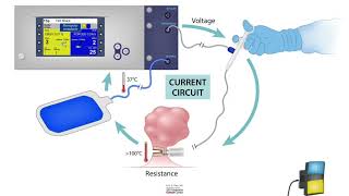 HCC 1472Lesson16bElectrosurgery Monopolar vs Bipolar devices [upl. by Eastlake]