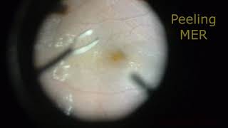 Vitrectomía 23g Paciente diabético Edema Macular Diabético Membrana Epirretinal MER [upl. by Annovaj]