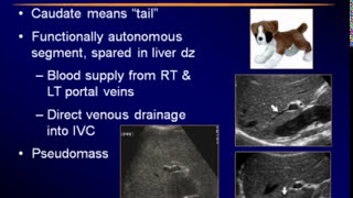 Sonography of the Liver [upl. by Sollars]