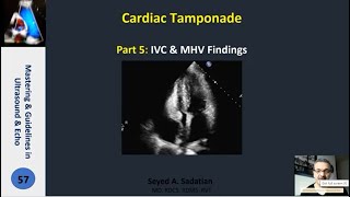 Cardiac Tamponade Part 5 IVC amp MHV Findings [upl. by Bram]