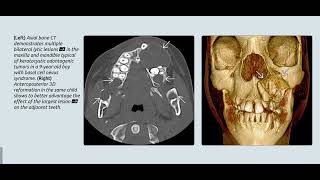 Neurofibromatosis neckㅣfibrous dysplasiaㅣCHARGE syndrome [upl. by Karlee]