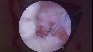 Modified Centralization Technique of Tibial Side Capsulodesis for Radial Tear of Incomplete Discoid [upl. by Eiramlehcar]