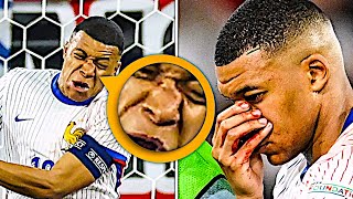 Mbappe broke his nose vs Austria 😱 [upl. by Nahor]