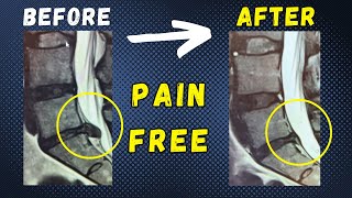 Lumbar Disc Extrusion L5 S1 recovery without surgery within 4 Months [upl. by Gunter]