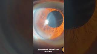 Iridodonesis amp Traumatic lens dislocation iridodonesis shorts ophthalmology kripanandkumar wwe [upl. by Itoc879]