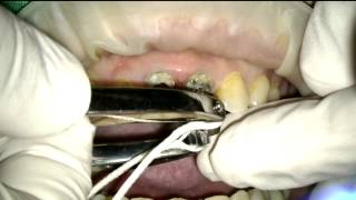 Extracting teeth with Exomed 1121 [upl. by Anelah]