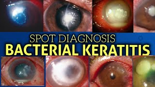 Bacterial keratitis  clinical features [upl. by Adnamor]