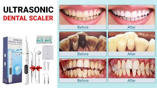 Best Ultrasonic Dental Scaler Review for Buyers  Home Dental Scaler [upl. by Arella]