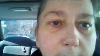 Chalazion Removal My 24 hour Review on my surgery [upl. by Yeslah]