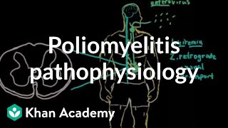 Poliomyelitis pathophysiology  Infectious diseases  NCLEXRN  Khan Academy [upl. by Nerhtak]