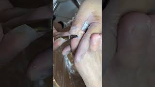 Ingrown toenail removal with Pedicure Knife Cut it easily Ep361 [upl. by Aninad]