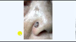 BASAL CELL CARCINOMA DR SAMEH GHAZY [upl. by Avrom]