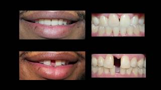 Invisaign for Teeth Gap Treatment at Cosmetic Dental Associates [upl. by Norod896]