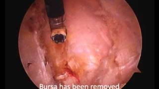 Arthroscopic Hip Bursectomy and Illiotibial Band Release [upl. by Tnomal]