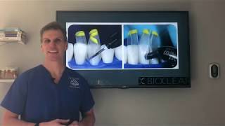 The best and easiest solution to closing tooth gaps Bioclear  Black triangles in teeth [upl. by Nonnad]