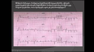 მოციმციმე არითმია წინაგულების ფიბრილაცია პარკუჭოვანი ექსტრასისტოლები და პარკუჭოვანი ტაქიკარდია [upl. by Nek]