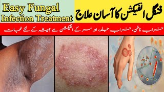 Fungal Infection Ka Asan Ilaj  Easy Fungal Infection Treatment  خراب ناخن کا علاج DrKashif Bilal [upl. by Anawd725]