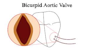 Bicuspid Aortic Valve BAV and Aortic Stenosis [upl. by Morehouse936]