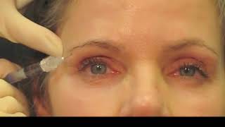 Filler Technique for Rejuvenation of the Upper Periocular Area [upl. by Llerrut]