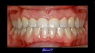 GingivoplastyGingivectomy [upl. by Nagirrek]