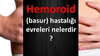 Hemoroid basur hastalığı evreleri nelerdir [upl. by Chic]