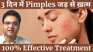 Pimples को बोलो अलविदा  4 Simple Steps To Remove Pimples amp Get Clear Spotless Skin Naturally [upl. by Ilene]