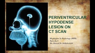 Periventricular hypodense lesions on CT scan Highlights In Radiology Episode 8 [upl. by Eiramlatsyrk]